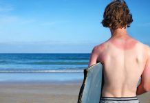 11 Home Remedies for Sunburn