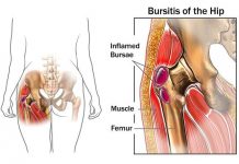 10 Common Symptoms of Bursitis