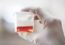 12 Causes of Blood in Urine