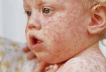 Measles Cases Reach the Highest Level in the United States in Two Decades