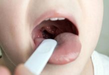 15 Strep Throat Symptoms