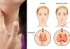 Top 10 Hyperthyroidism Symptoms