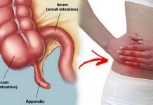 11 Common Symptoms & Signs of Appendicitis