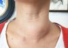 Symptoms of Hashimoto Disease