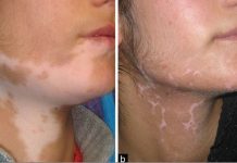 10 Common Treatments of Vitiligo