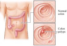 10 Causes of Colon Polyps