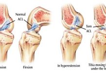 Knee Pain: Causes, Symptoms and Treatments