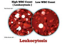 Leukocytosis: Symptoms, Causes and Treatments
