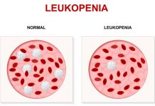 Leukopenia: Symptoms, Causes, and Treatments