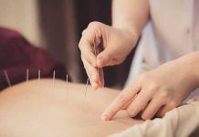 Health Benefits of Acupuncture