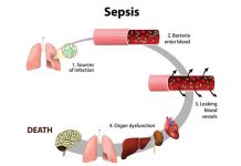 10 Most Common Sepsis Treatments
