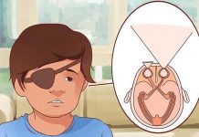 Facts about Lazy Eye (Amblyopia) in Children