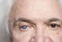 Cataract Causes & Treatments