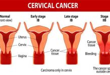 10 Cervical Cancer Signs