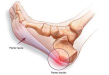 10 Causes of Plantar Fasciitis