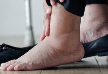 Causes of Swollen Ankles