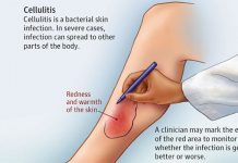 Cellulitis: Causes, Symptoms & Treatments