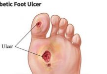 Diabetic Foot Pain – Symptoms, Causes & Treatments