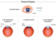 Cataract Surgery – Everything You Need to Know