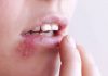 10 Symptoms of Herpes