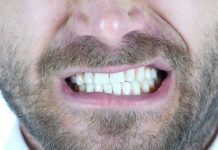 Bruxism (Teeth Grinding) – Symptoms & Causes
