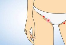 Common Symptoms of HPV