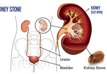 10 Causes of Kidney Stone