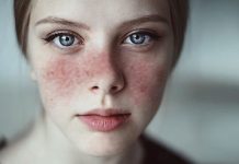 10 Causes of Lupus