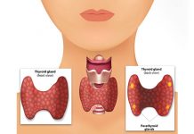 10 Parathyroid Disease Symptoms