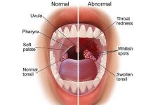 8 Causes and Risk Factors of Strep Throat