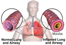 Can Asthma Cause COPD – Differences & Similarities