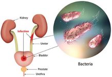 10 Causes of Bladder Infection