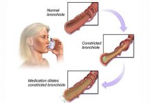 Allergic Asthma – Symptoms, Causes & Treatment