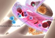 8 Types of Multiple Myeloma