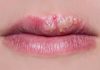 Herpes – Stages, Tests & Diagnosis