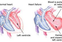 4 Types of Heart Failure