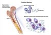 Multiple Myeloma – Causes & Risk Factors