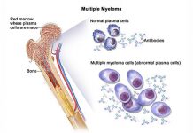 Multiple Myeloma – Causes & Risk Factors