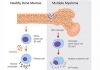 Multiple Myeloma – Prognosis & Life Expectancy