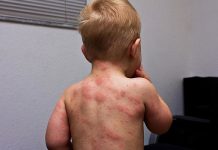8 Types of Herpes Virus & Infections