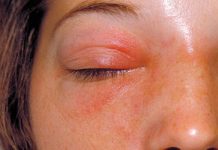Facts of Periorbital Cellulitis