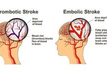 10 Facts of Ischemic Stroke