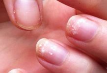 Nail Fungus – Symptoms & Causes