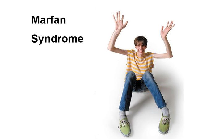 Marfan Syndrome Mnemonic 2512