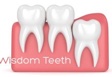 Home Remedies for Wisdom Tooth Pain
