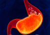 Hiatal Hernia – Symptoms and Causes