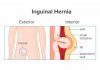 Inguinal(Groin) Hernia – Symptoms and Causes