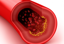 High Cholesterol – Symptoms and Causes