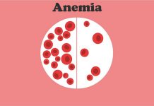Anemia – Diagnosis and Treatment
