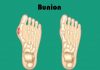 What is Bunion – 10 Facts to Know